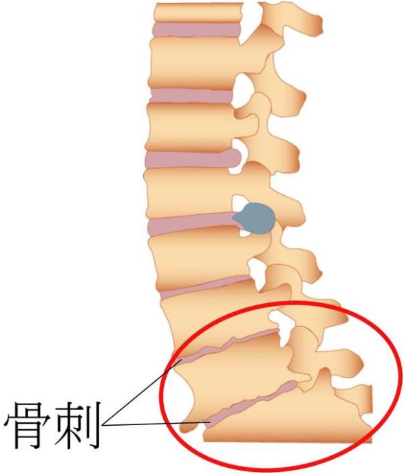 吉林长春|草莓软件APP下载超声草莓视频入口仪厂家品牌分享:为什么现在的年轻人也存在骨刺增生?